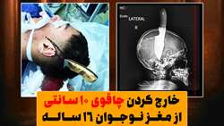 موفقیت تیم پزشکی در جراحی جمجمه شکافته شده / تیغه 10 سانتی چاقو از مغز نوجوان 16 ساله خارج شد 