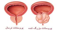 بزرگی پروستات را با سرطان پروستات اشتباه نگیریم