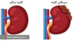 غربالگری منظم، کلید پیشگیری و درمان به‌موقع سرطان کلیه است