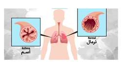تشخیص زودهنگام و کنترل عوامل محرک را در بیماری آسم جدی بگیرید 
