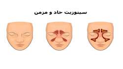 ۹۵ درصد بیماران مبتلا به سینوزیت مزمن بدون نیاز به جراحی درمان می‌شوند