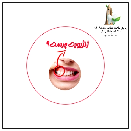  پیشگیری و درمان ژینژیویت از زبان عضو هیئت علمی گروه پریودنتولوژی دانشکده دندانپزشکی همدان  