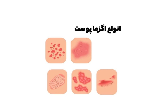 علائم اگزمای پوستی/ تشدید اگزما در استان همدان به دلیل آب هوای سرد خشک