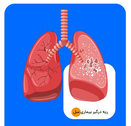 انجام رایگان آزمایش سل در خانه‌های بهداشت و مراکز خدمات جامع سلامت روستایی و شهری تویسرکان 