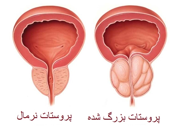 بزرگی پروستات را با سرطان پروستات اشتباه نگیریم