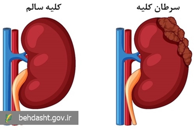 غربالگری منظم، کلید پیشگیری و درمان به‌موقع سرطان کلیه است