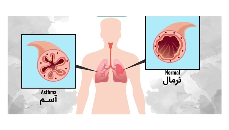 تشخیص زودهنگام و کنترل عوامل محرک را در بیماری آسم جدی بگیرید 