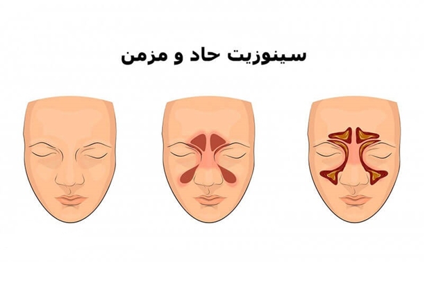 ۹۵ درصد بیماران مبتلا به سینوزیت مزمن بدون نیاز به جراحی درمان می‌شوند